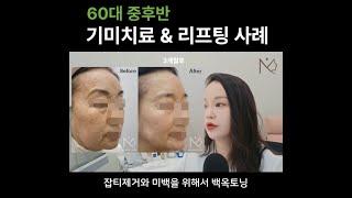 미사피부과 추천 I 기미잡티제거 레이저토닝 시술과 리프팅으로 젊어지신 60대 환자분 사례