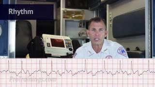 Atrial Fibrillation (ECG Rhythm Interpretation)