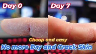 Say Goodbye to CRACKED SKIN in Just 7 Days? #skincare #dryskin #skincaretips by Benson Chik