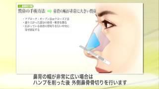 【東京美容外科】わかりやすい“鼻”の解説20C「鷲鼻の手術方法鼻背の幅が非常に大きい鷲鼻」