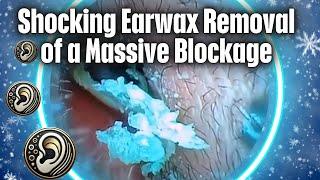 Shocking Earwax Removal of a Massive Blockage