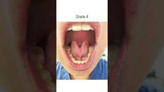 Tongue Tie: Severity Grades 1-4 (Tongue Range of Motion Ratio)