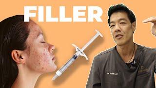 How to Fix ACNE SCARS with Dermal Filler | Dr Davin Lim