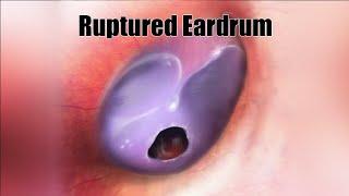 Ruptured Eardrum (Perforated Eardrum)