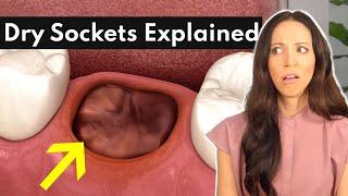 Blood Clots Are GOOD!? | Dry Sockets Explained