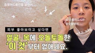 eng) 지긋지긋한 편평사마귀...해방가능?!치료, 재발 막는 방법 (홈케어 포함) | 피부과전문의