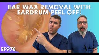 EAR WAX REMOVAL WITH EARDRUM PEEL OFF - EP976