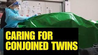 Caring for conjoined twins