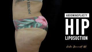 Before & After Liposuction, Hip Liposuction Procedure  · Rancho Cucamonga, Inland Empire