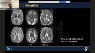 Radiological Diagnosis and Approach to Leukodystrophies