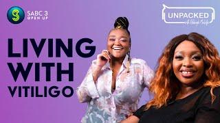 My life with Vitiligo  | Unpacked with Relebogile Mabotja - Episode 32| Season 2