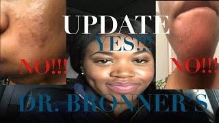 UPDATE | DR. BRONNER’S PEPPERMINT SOAP! | OVER A YEAR USING IT | DOES IT STILL WORK? | SKIN | GLOWUP