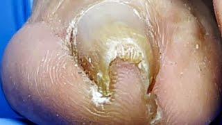 Wow, The Ingrown Nail Is So Curled, Save The Nail【Pedicure Master Lin Jun】