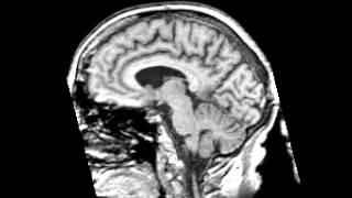 Normal Aging Sagittal Plane motion picture