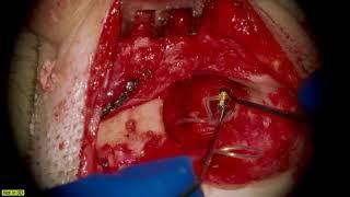 Congenital Aural Atresia and Active Middle Ear Implant Surgery by Prof. Thomas Linder 2D 1080p