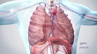 How It Works: What is Collateral Ventilation?