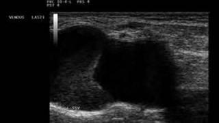 Phlebology Biosound Esaote MyLab 25 Great Saphenous Vein