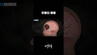 두통의 종류