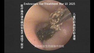 Cleaning of soft earwax in children 20250310