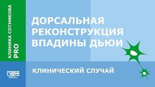 Дорсальная реконструкция впадины Дьюи. Клинический случай