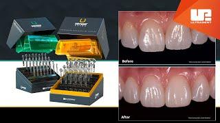 Uveneer® and Uveener® Extra | Direct Veneer Template System