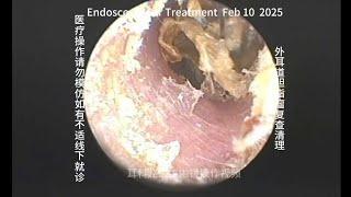 Re examination and cleaning of external auditory canal cholesteatoma 20250210