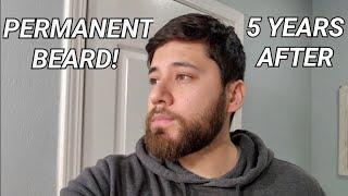 5 Years After Stopping Minoxidil On My Beard | PERMANENT RESULTS!