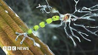 'Truly remarkable' drug can reverse decline caused by motor neurone disease - BBC News