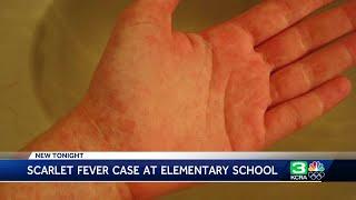 Case of scarlet fever confirmed at Elk Grove elementary school