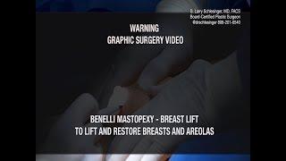 Benelli Breast Lift | Mastopexy Surgery - Dr. Schlesinger, Oahu, Hawaii