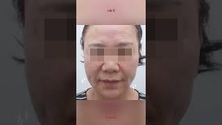 나이들어보이는 입가주름 굿바이~ #입가주름필러 #실리프팅 #앞볼필러