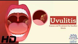 Uvulitis Explained: What's Causing Your Swollen Uvula?