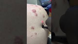 How dermatologists treat keloid scarring #shorts #dermatologist