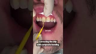 Fixing a chipped front tooth | composite bonding | Cosmetic Dentist Dr Yazdan