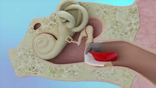 Eardrum Hole Repair Animation