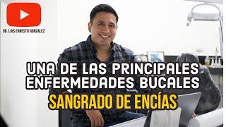 Una de las principales enfermedades bucales, Sangrado de las encías