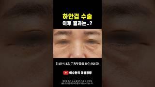 하안검 수술 결과를 공개합니다..! #하안검 #눈밑꺼짐 #눈밑지방 #동안 #동안성형