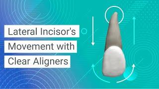 Lateral Incisor's Movement with Clear Aligners