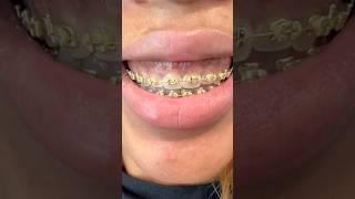 Gold braces  #braces