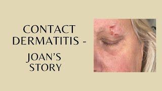 Contact Dermatitis - Joan's Story