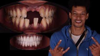 DENTAL DESIGN COST IN TURKEY ANTALYA | Hollywood Smile Makeover Cost in Antalya Turkey