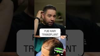  Is FUE Hair Restoration really that easy?!