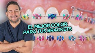 EL MEJOR y PEOR COLOR DE LIGAS PARA TÚ TRATAMIENTO DE BRACKETS + COMBINACIONES DE COLORES ORTODONCIA