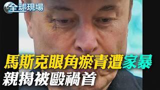 馬斯克離職記者會 川普親贈"白宮金鑰匙"｜馬斯克眼角瘀青遭"家暴" 親揭被毆禍首【全球現場】20250531 ‪@全球大視野Global_Vision