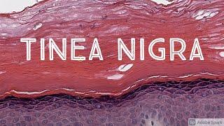 Tinea Nigra: Black Mold Skin Infection (Dematiaceous Pigmented Fungus) 5-Minute Pathology Pearls