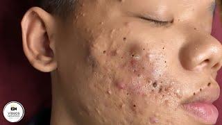 Squeezing Blackheads and Pimples - Relaxing and Satisfying 