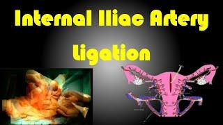 Internal Iliac Artery Ligation / Internal Iliac artery Ligation Procedure