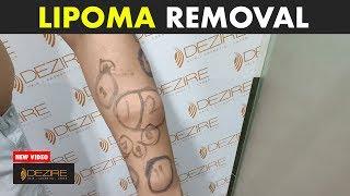 Excision of Lipoma ( Multiple Lipoma Removal ) By Dr. Prashant Yadav  @dezireclinic