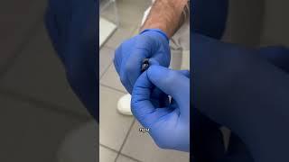 Скоба 3ТО #подолог #подология #nails #скоба #3то #ногти #podology
