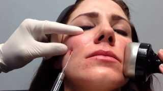 Voluma (Quick Demonstration) for Cheek Enhancement with Blunt Cannula, Steve Weiner, MD, Destin